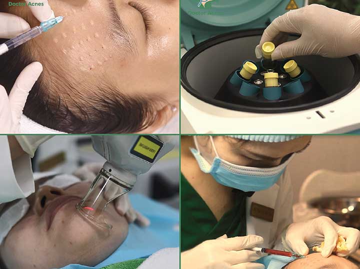 Điều trị sẹo do mụn tại pk doctor acnes 