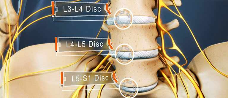Bệnh gai cột sống L4, L5 là gì?
