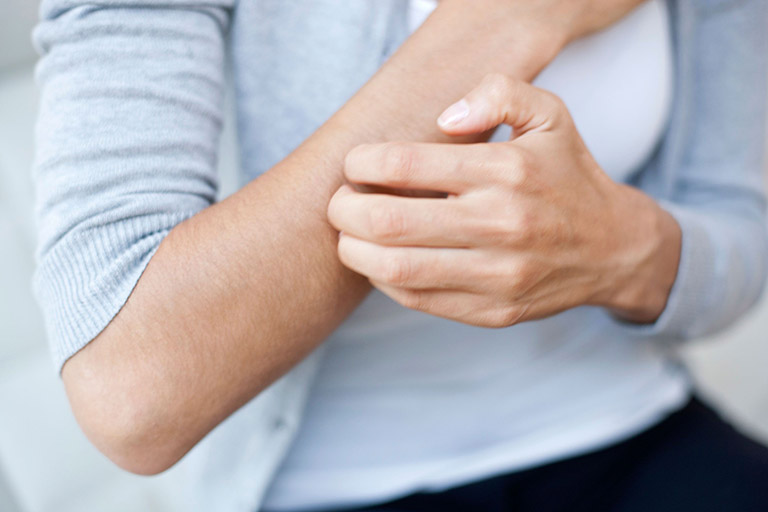 Sốt xuất huyết có ngứa không? Nguyên nhân vì đâu?