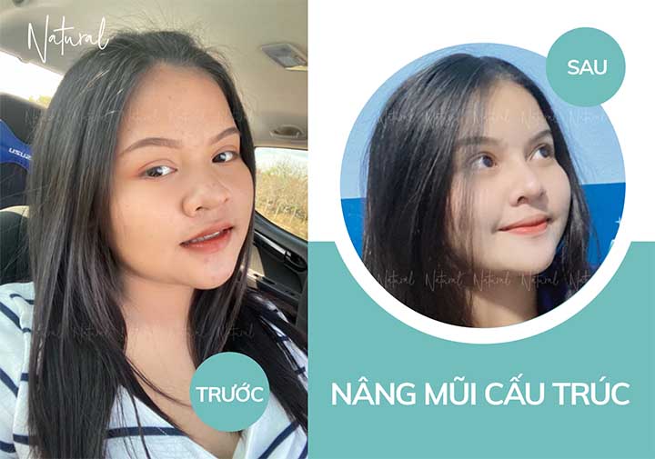 Trước và sau khi thu gọn mũi