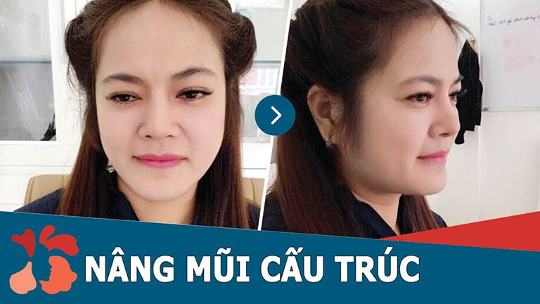 các dáng mũi đẹp