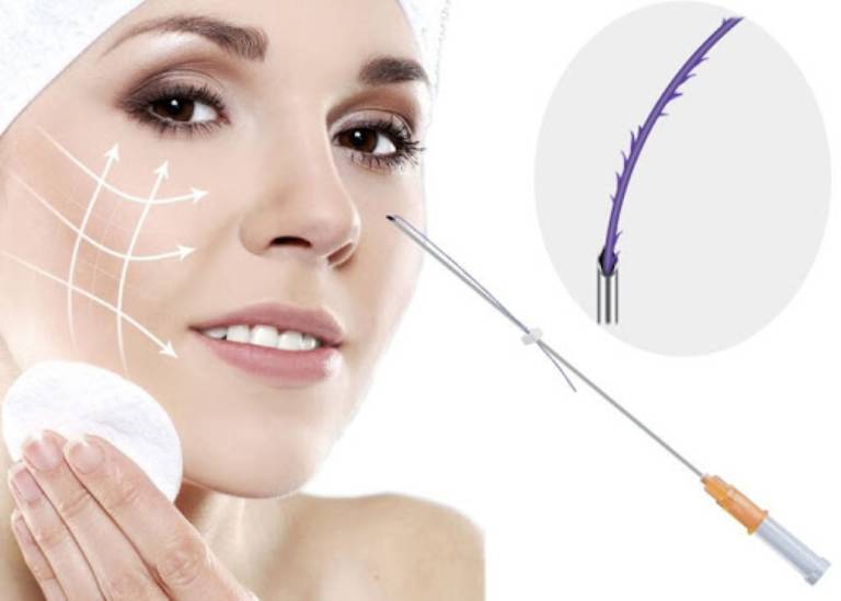 Thu gọn cánh mũi to và dày bằng chỉ