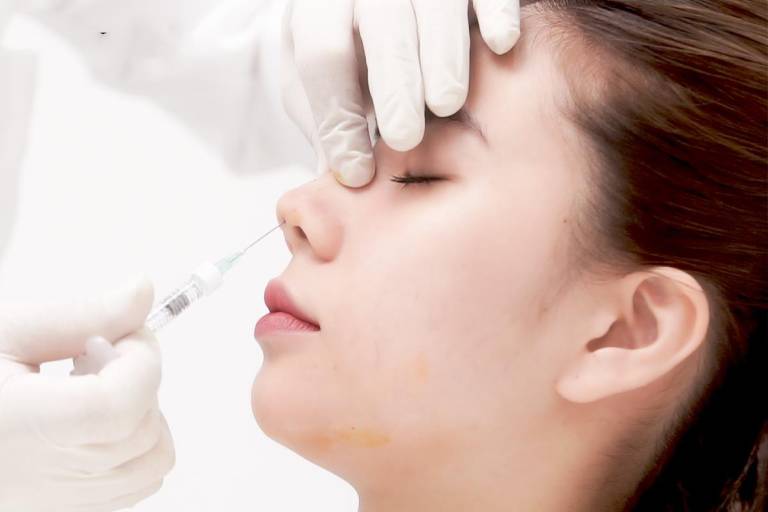 Tiêm filler nâng mũi giúp thu gọn cánh mũi
