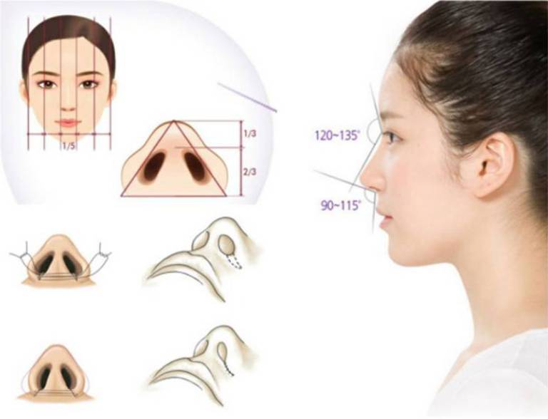 Phẫu thuật cắt cánh mũi