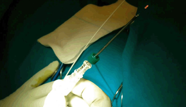 Cắt trĩ bằng laser bao nhiêu tiền?