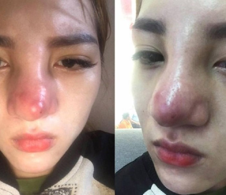 Nâng mũi 2 tháng vẫn sưng