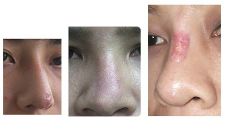 Nâng mũi 7 ngày mà vẫn còn sưng