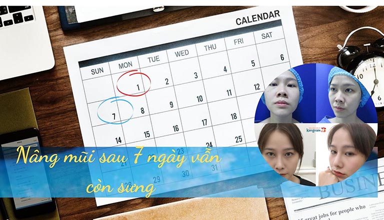 Nâng mũi 7 ngày mà vẫn còn sưng