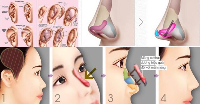 Nâng mũi 7 ngày mà vẫn còn sưng