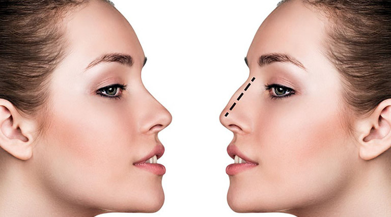 Nâng mũi bằng chỉ vàng 24k