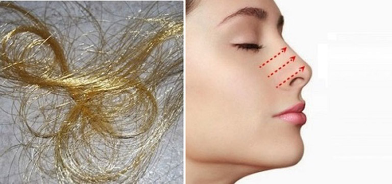 Nâng mũi bằng chỉ vàng 24k