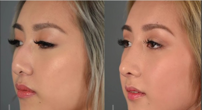 Nâng mũi bằng chỉ vàng 24k