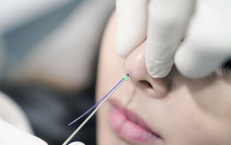 Phương pháp nâng mũi bằng chỉ