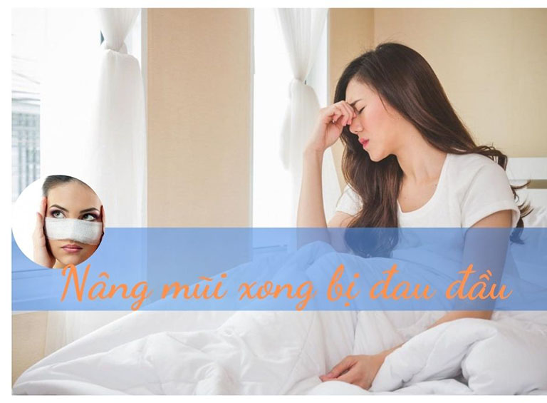 Nâng mũi xong bị đau đầu