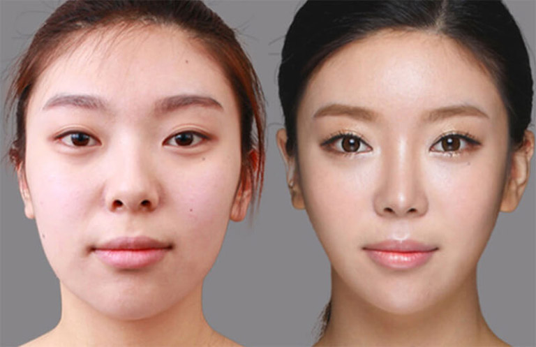 Phẫu thuật cắt cánh mũi có đau không?