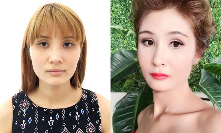 Phẫu thuật cắt cánh mũi có đau không?