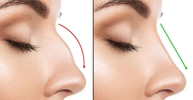 Phẫu thuật cắt cánh mũi có đau không?