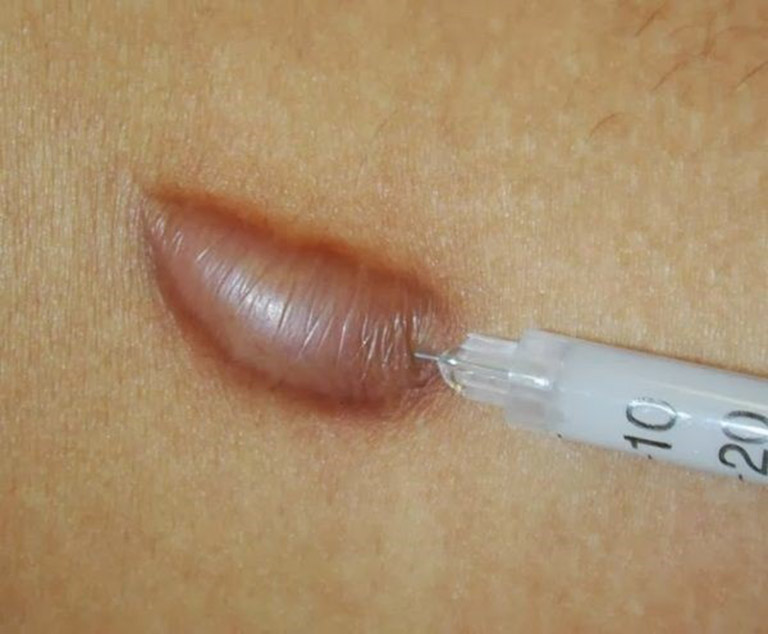Sẹo lồi