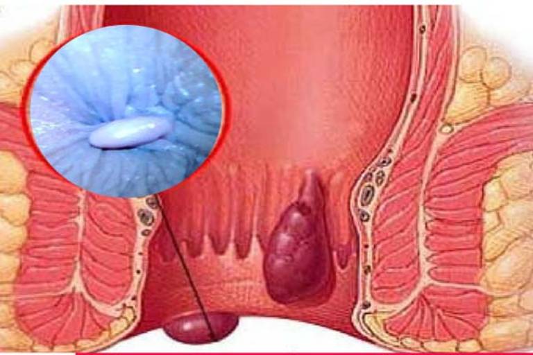 Nếu không kịp thời điều trị có thể gây ra nhiều biến chứng nguy hiểm