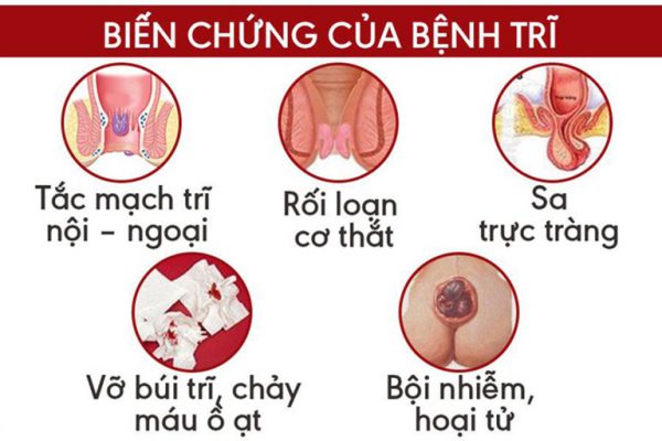 Búi trĩ sưng đau