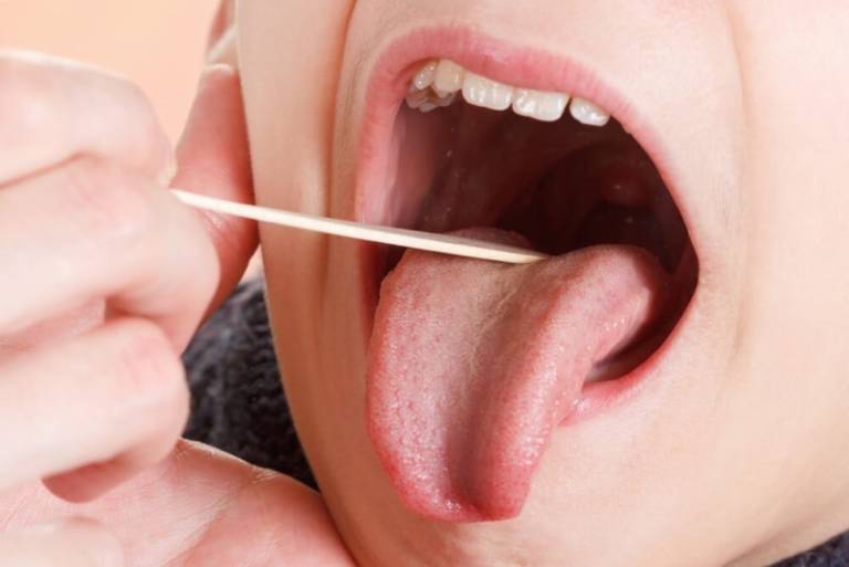 Viêm họng hạt là bệnh thường xuyên tái phát gây ảnh hưởng đến sức khỏe của người bệnh