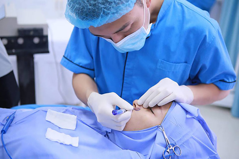Nâng mũi đầu mũi bị to