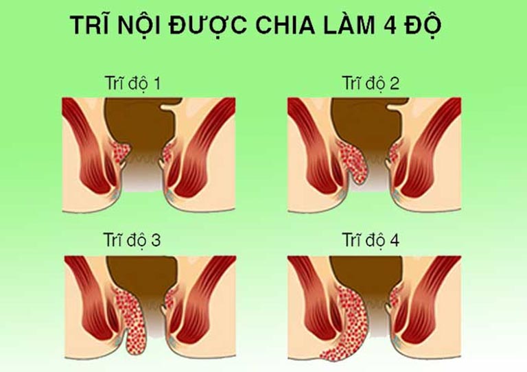 Sa búi trĩ