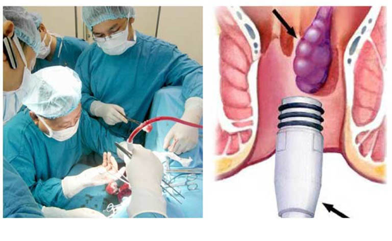 thắt búi trĩ bằng vòng cao su