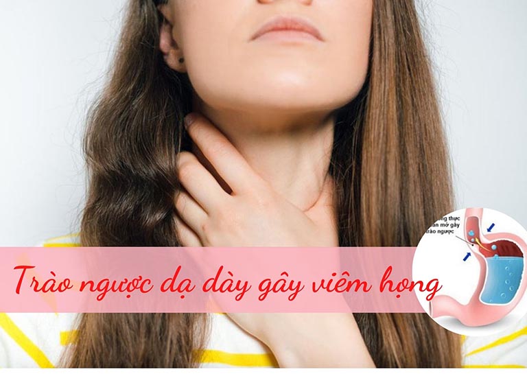 Trào ngược dạ dày gây viêm họng