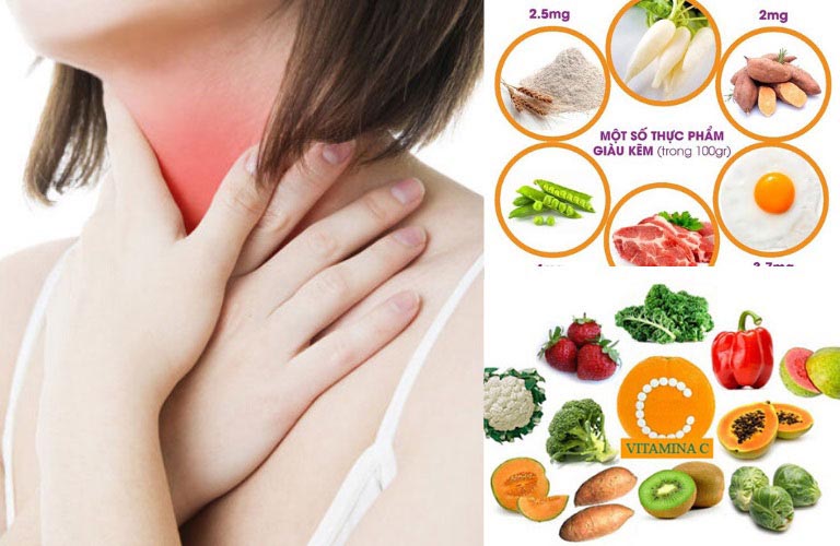 Viêm họng có hạt trắng