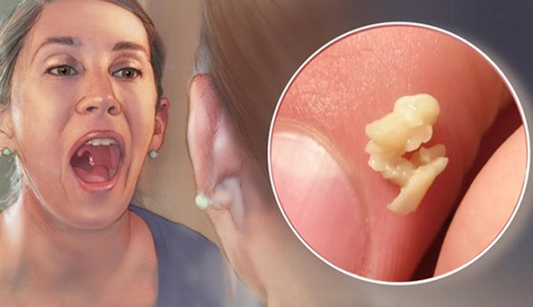Viêm họng có hạt trắng