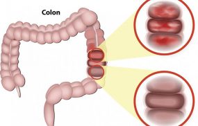 Viêm loét đại trực tràng chảy máu