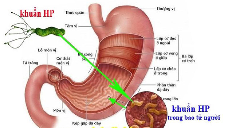 Viêm teo niêm mạc dạ dày