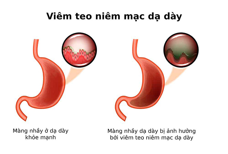 Viêm teo niêm mạc dạ dày