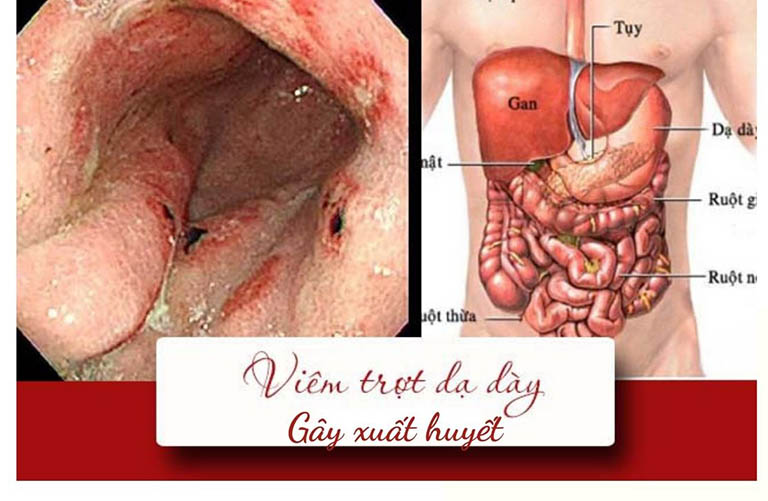 Viêm trợt dạ dày xuất huyết