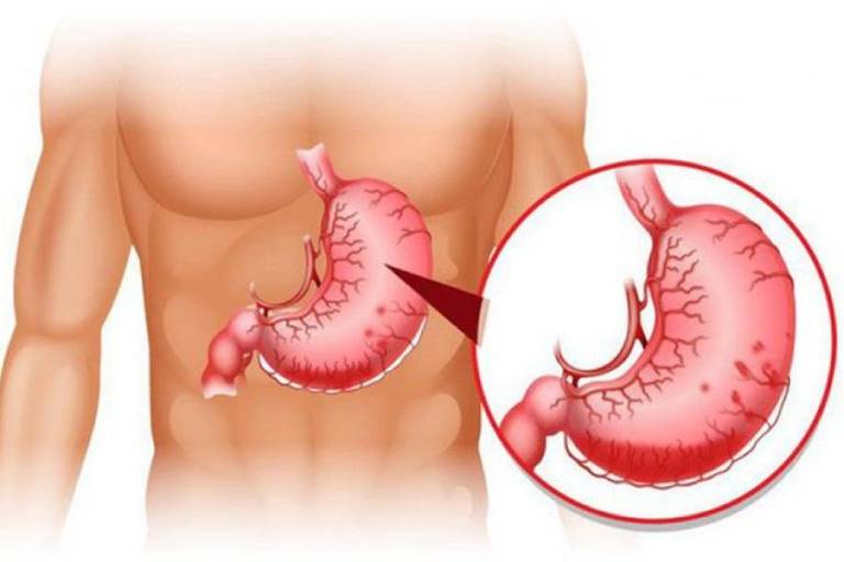 Giãn tĩnh mạch dạ dày gây rách tĩnh mạch khiến dạ dày viêm, chảy máu