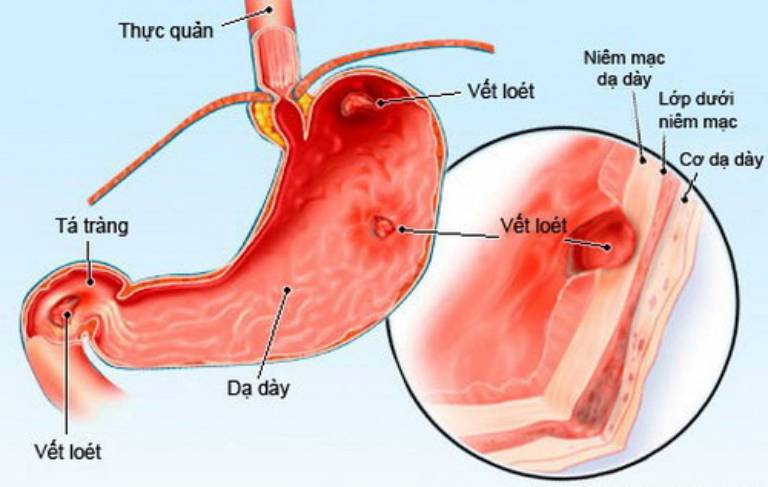Viêm xuất huyết niêm mạc dạ dày là tình trạng tổn thương lớp màng niêm mạc gây hiện tượng viêm và xuất huyết
