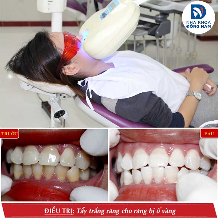 Tẩy trắng răng tại tphcm nha khoa đông nam