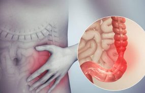 Viêm đại tràng co thắt là tình trạng rối loạn chức năng ruột nhưng không tìm thấy tổn thương thực thể ở ruột