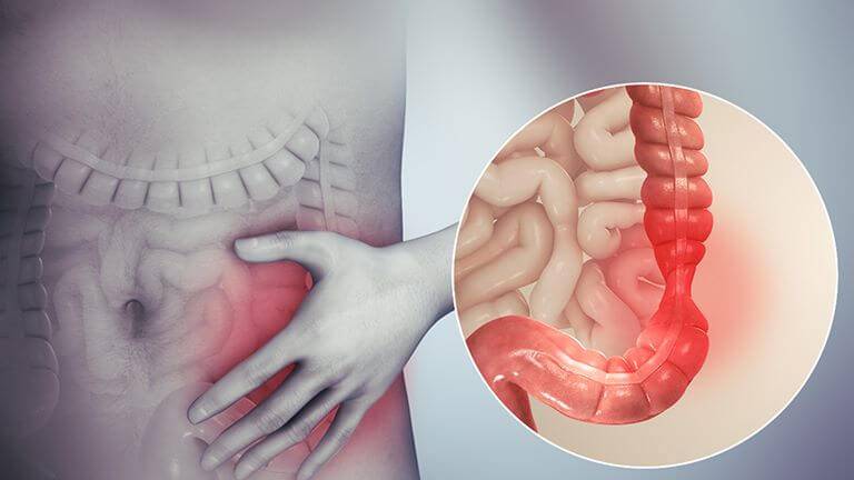Viêm đại tràng co thắt là tình trạng rối loạn chức năng ruột nhưng không tìm thấy tổn thương thực thể ở ruột