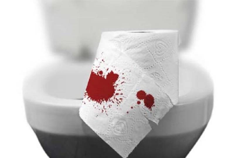 Viêm đại tràng đi ngoài ra máu và cách xử lý