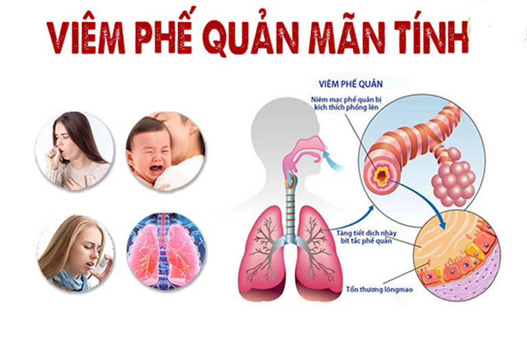 Viêm phế quản mãn tính