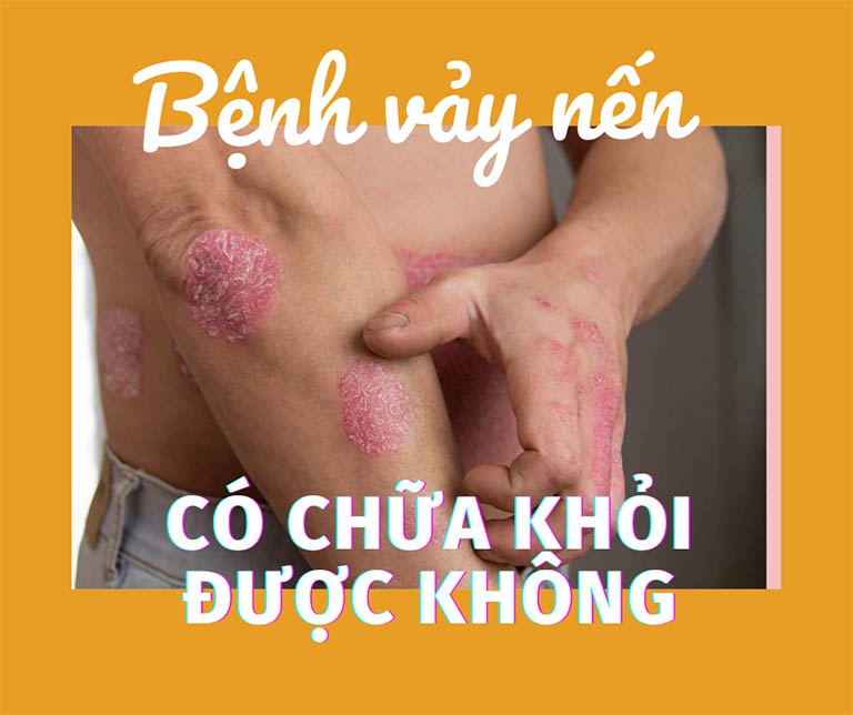 Bệnh vẩy nến có chữa khỏi được không?