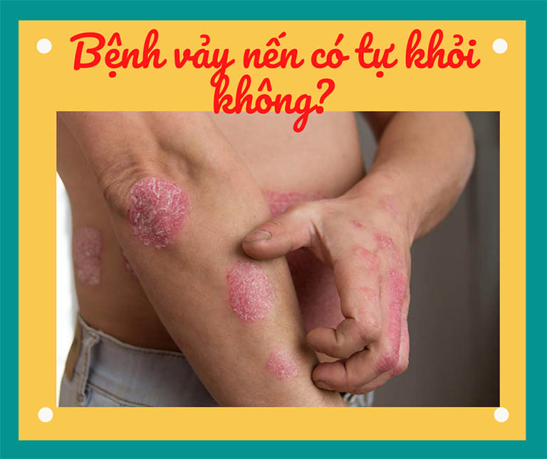 Bệnh vảy nến có tự khỏi không?