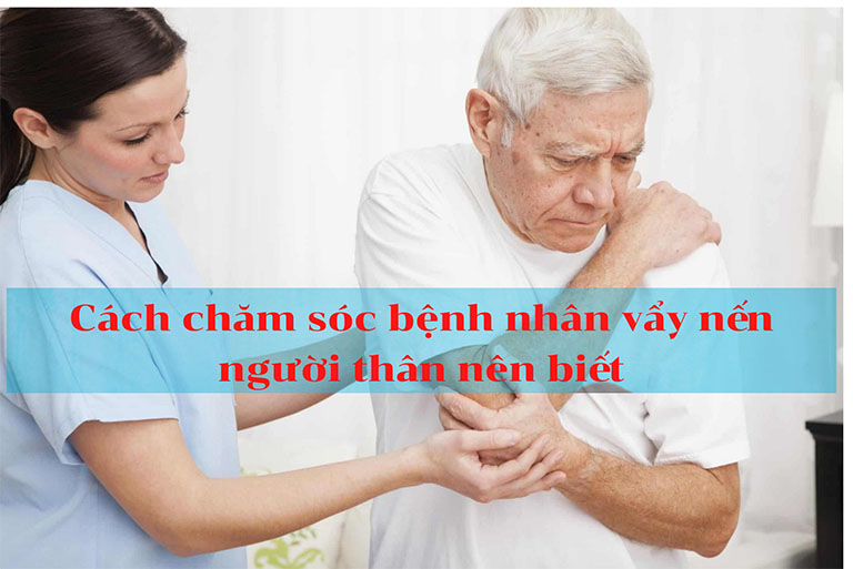 Cách chăm sóc bệnh nhân vẩy nến