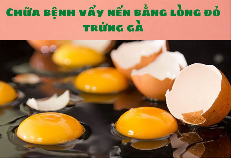 Chữa bệnh vẩy nến bằng lòng đỏ trứng gà