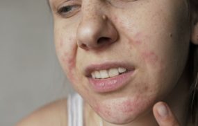 Da mặt bị dị ứng thời tiết