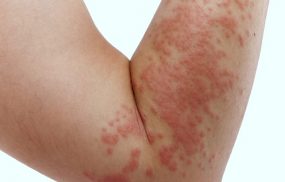 Dị ứng thời tiết nổi mề đay, mẩn đỏ