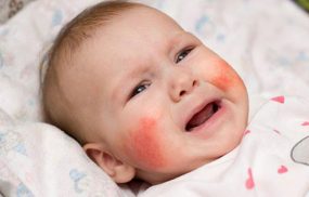 Dị ứng thời tiết ở trẻ sơ sinh