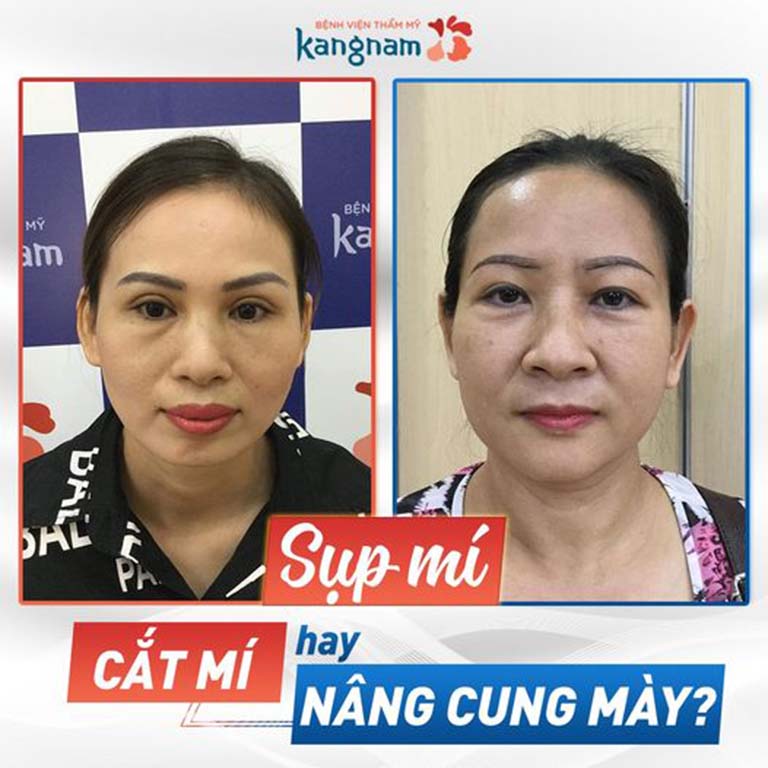địa chỉ cắt nhấn mí mắt đẹp ở Hà Nội